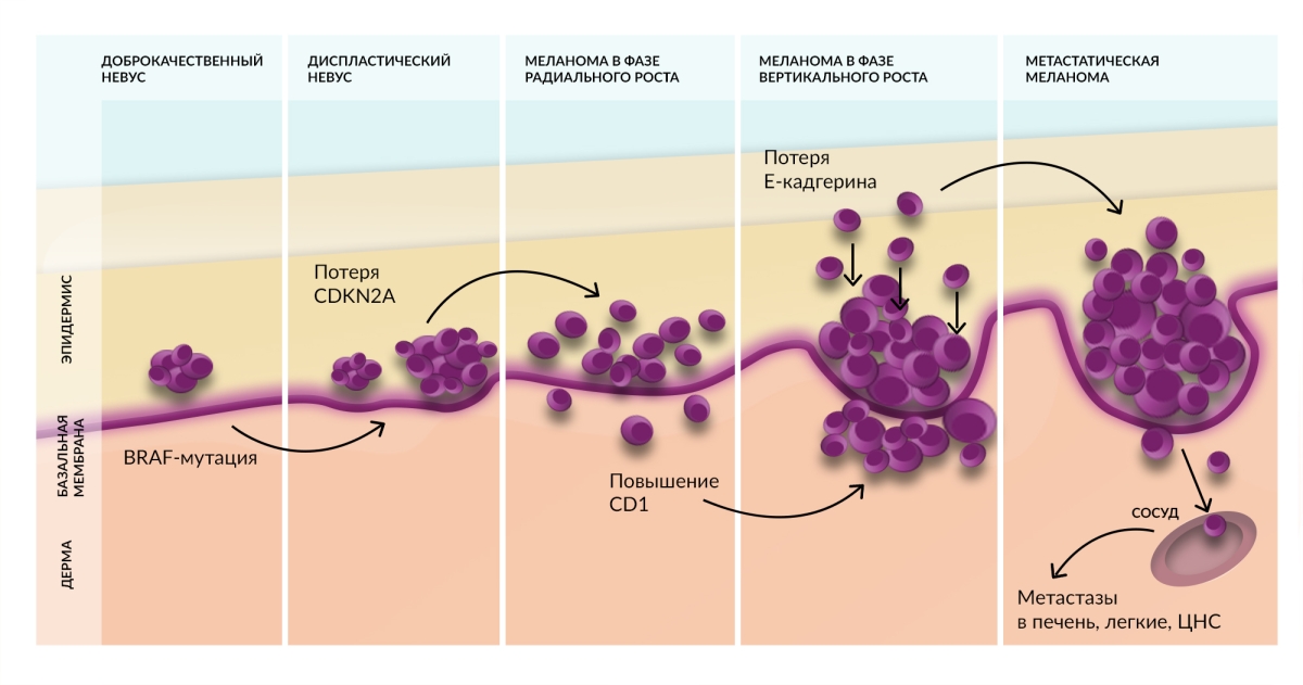 Прогрессия меланомы