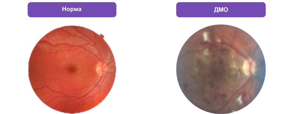 Исследование глазного дна при офтальмоскопии (норма и ДМО)