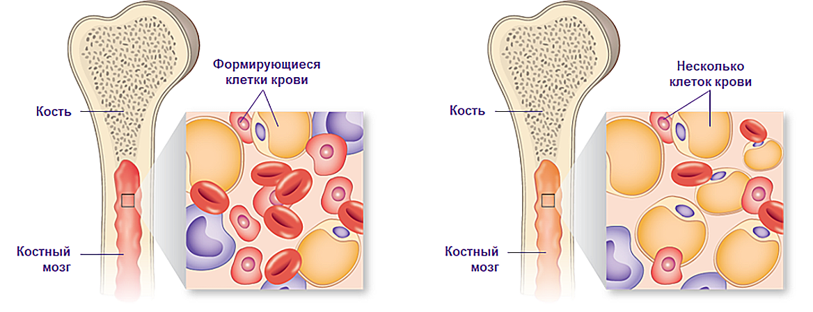 Деструкция костного мозга и недостаточность гемопоэза