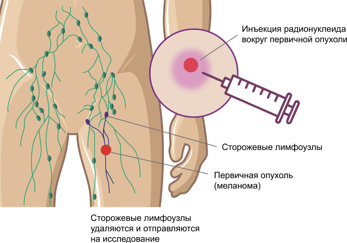 Техника проведения БСЛУ