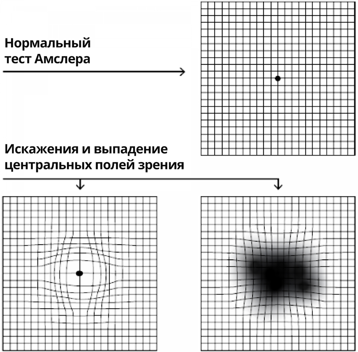Рисунок 2 — Тест Амслера Тест Амслера