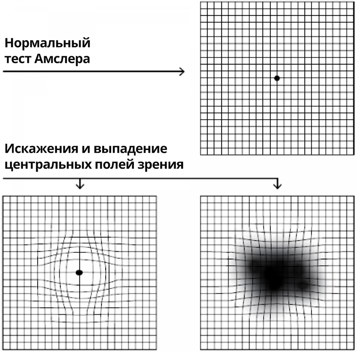 Тест Амслера