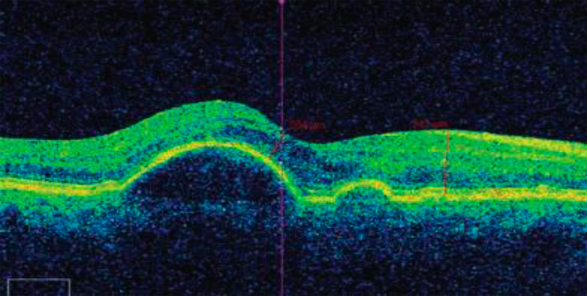 ОКТ макулы пациента с отслойкой пигментного эпителия