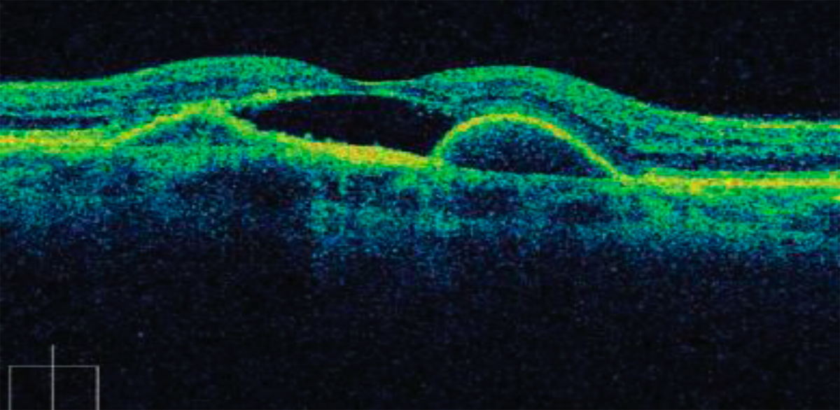 ОКТ макулы пациента с субретинальной неоваскулярной мембраной