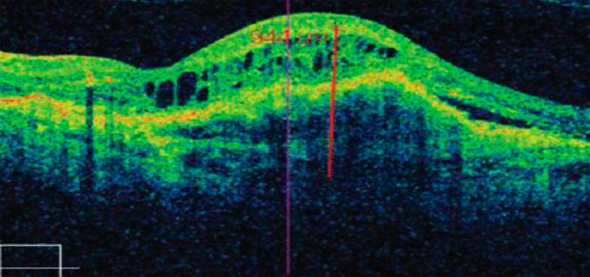 ОКТ макулы пациента с макулярным фиброзом