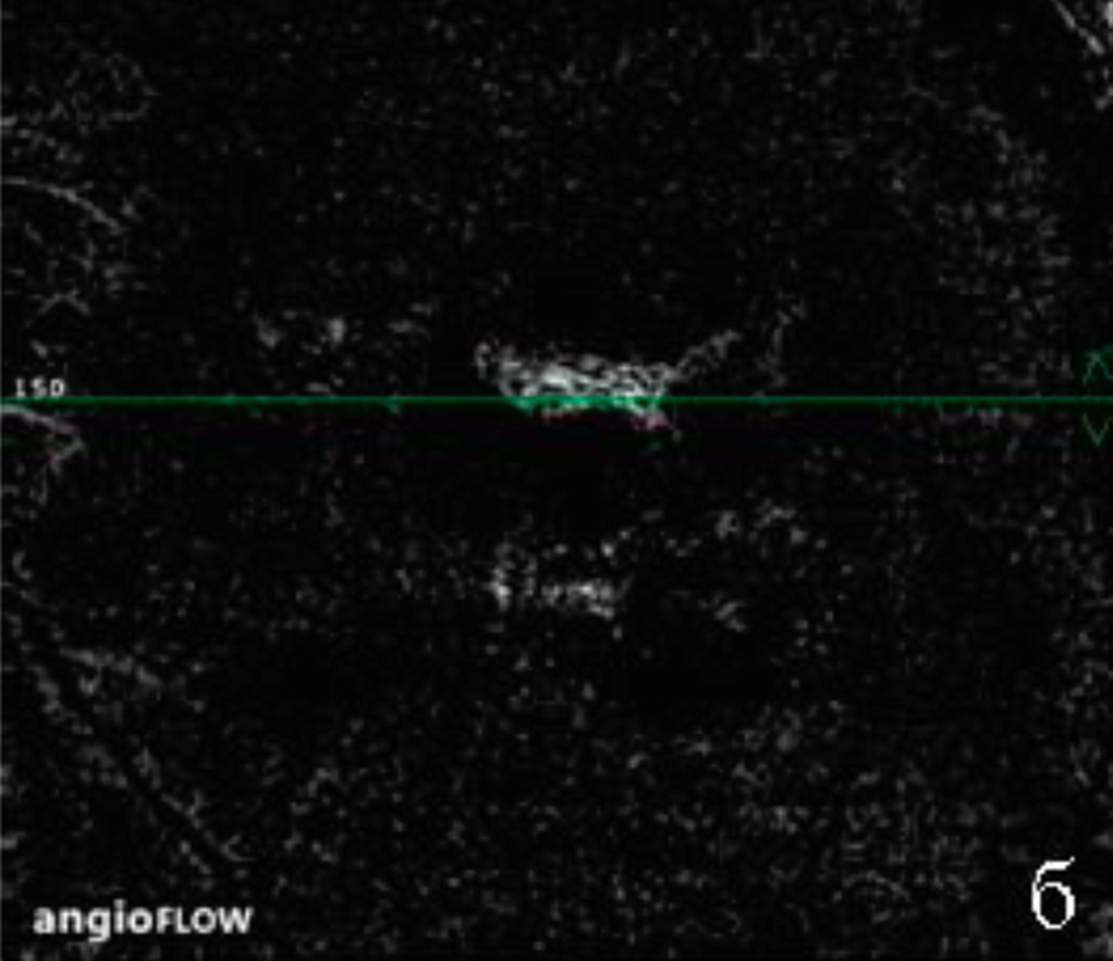 Флюоресцентная ОКТ-ангиограмма