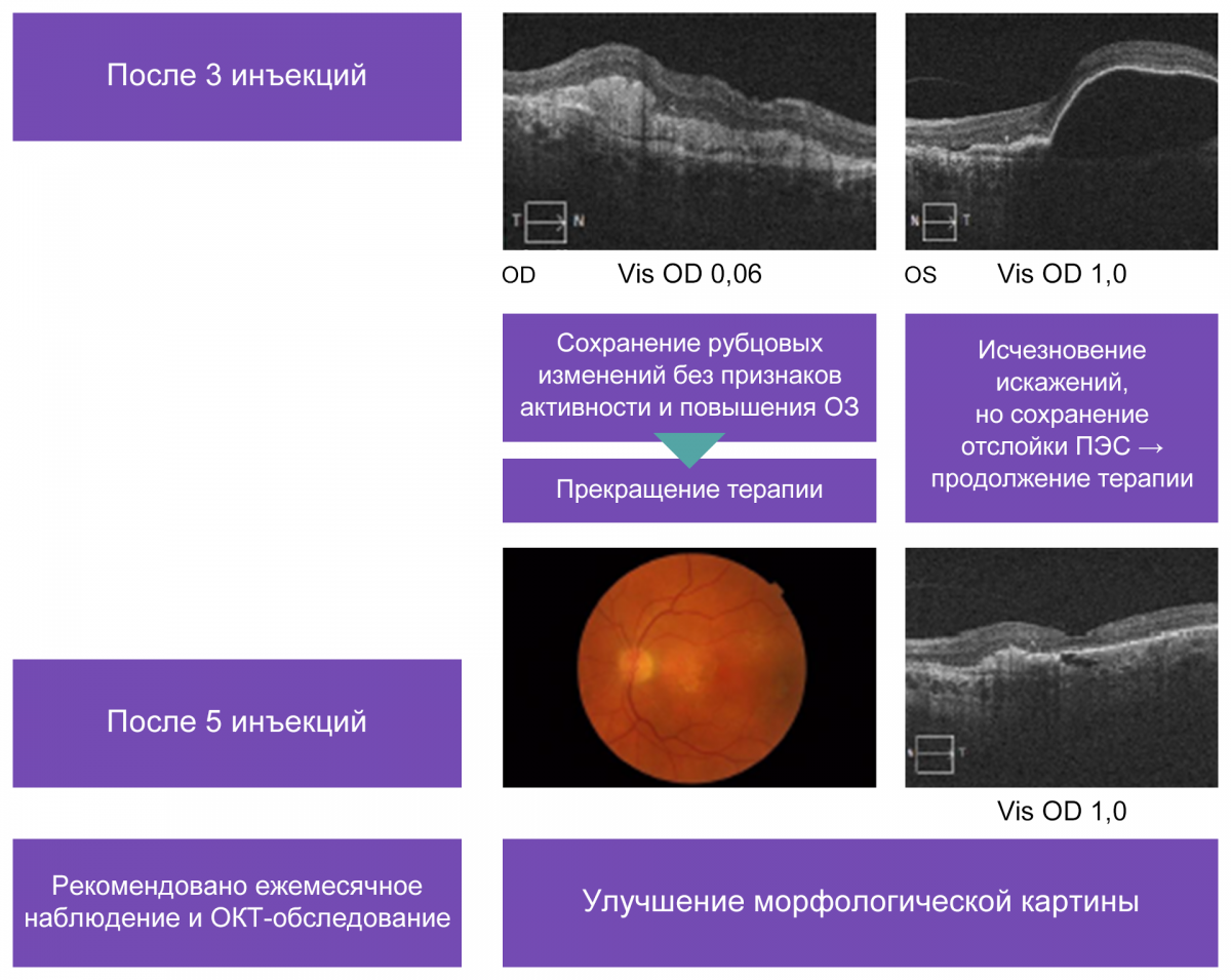 Динамика изменений на фоне анти-VEGF-терапии