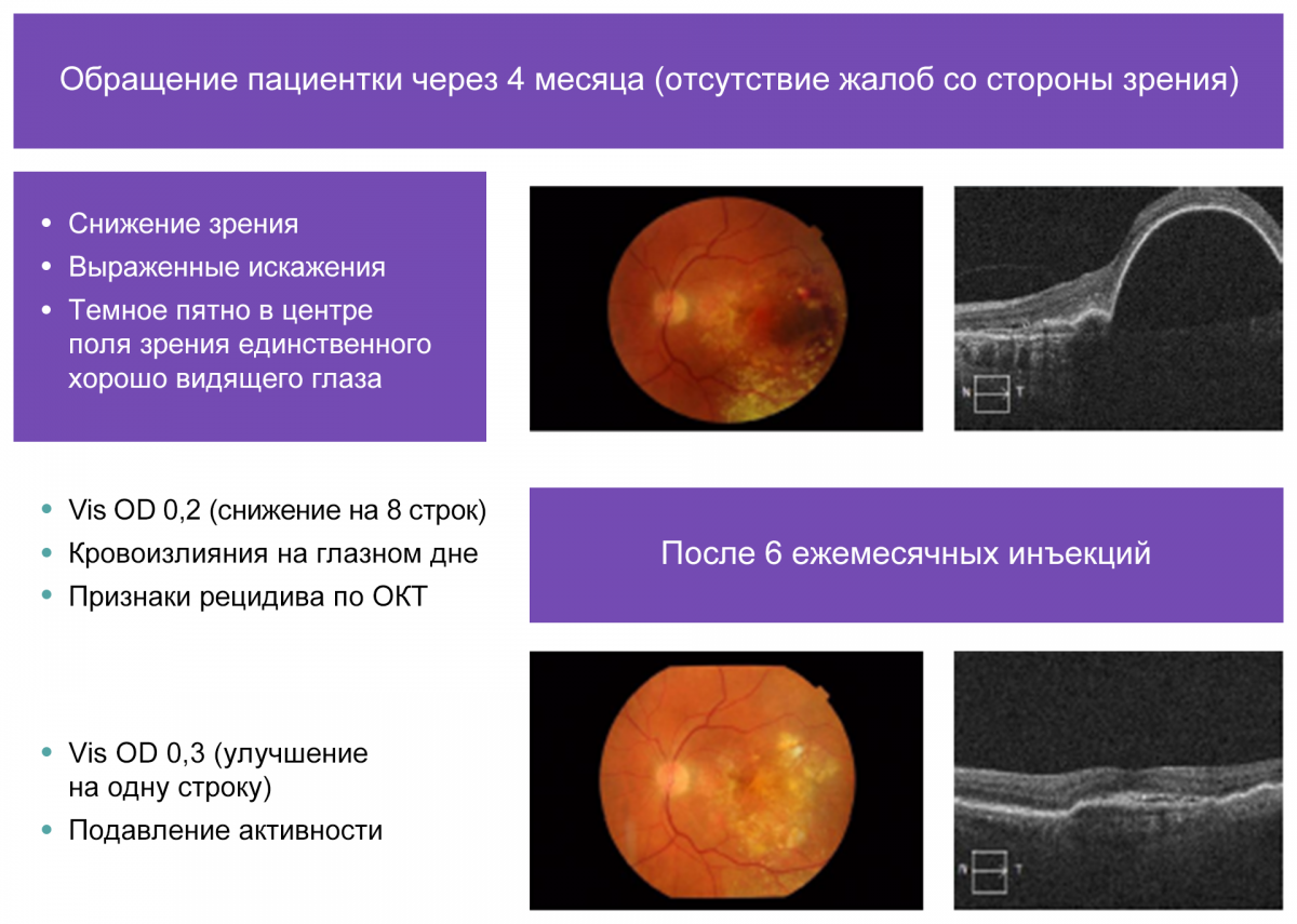 Рисунок 7. Динамика изменений после прекращения и возобновления анти-VEGF-терапии Динамика изменений после прекращения и возобновления анти-VEGF-терапии