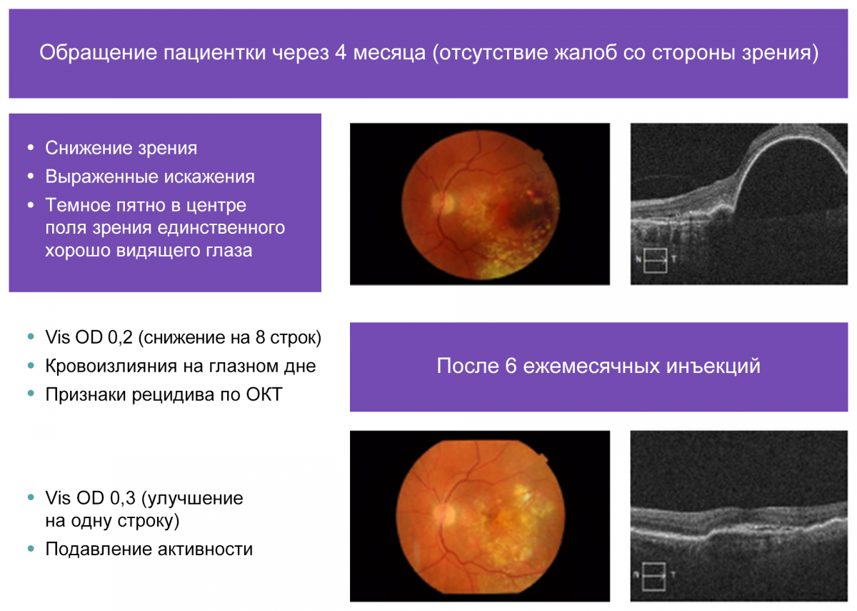 Динамика изменений после прекращения и возобновления анти-VEGF-терапии