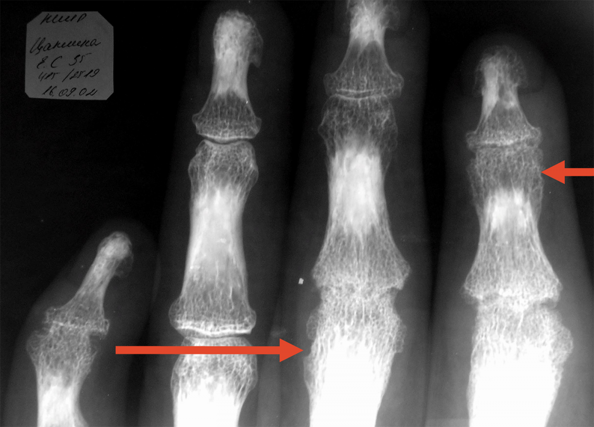 Прицельная рентгенография межфаланговых суставов кисти