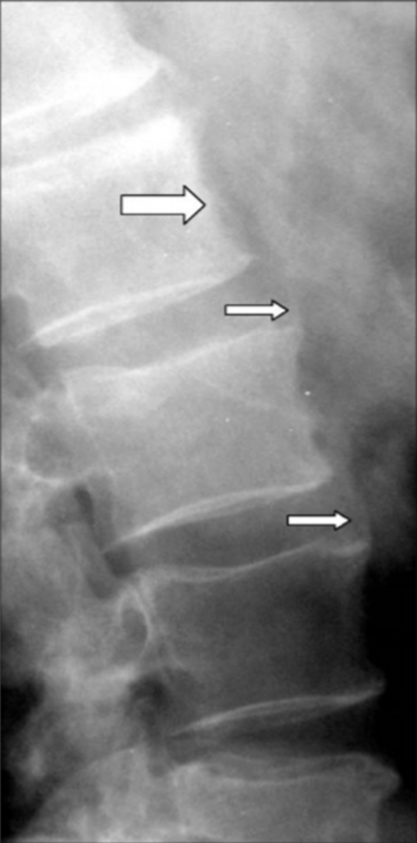 Формирующиеся множественные синдесмофиты в области передних углов тел позвонков