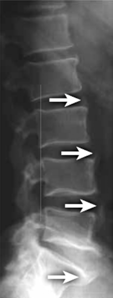 Рентгенография поясничного отдела позвоночника в боковой проекции