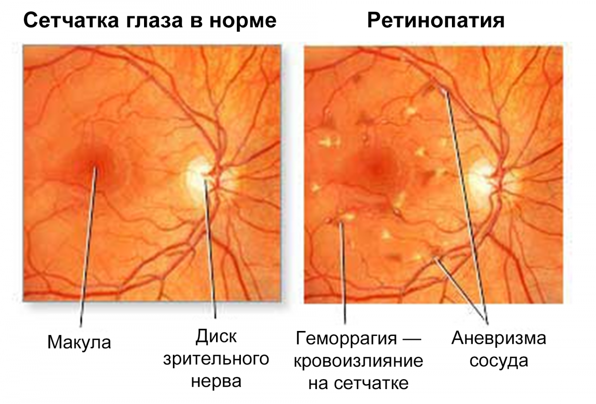 Рисунок 5. Изменения глазного дна при НПДР Изменения глазного дна при НПДР