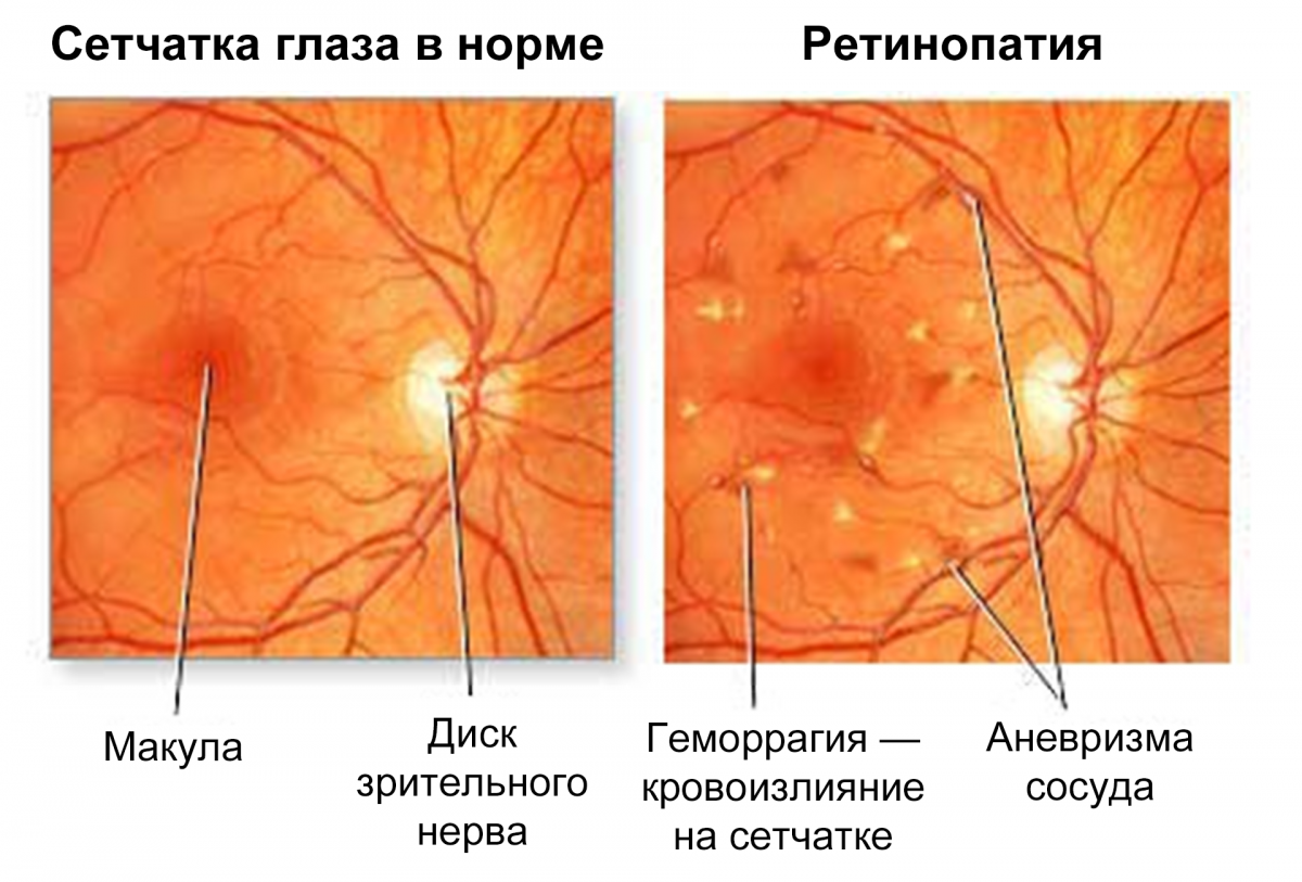 Изменения глазного дна при НПДР