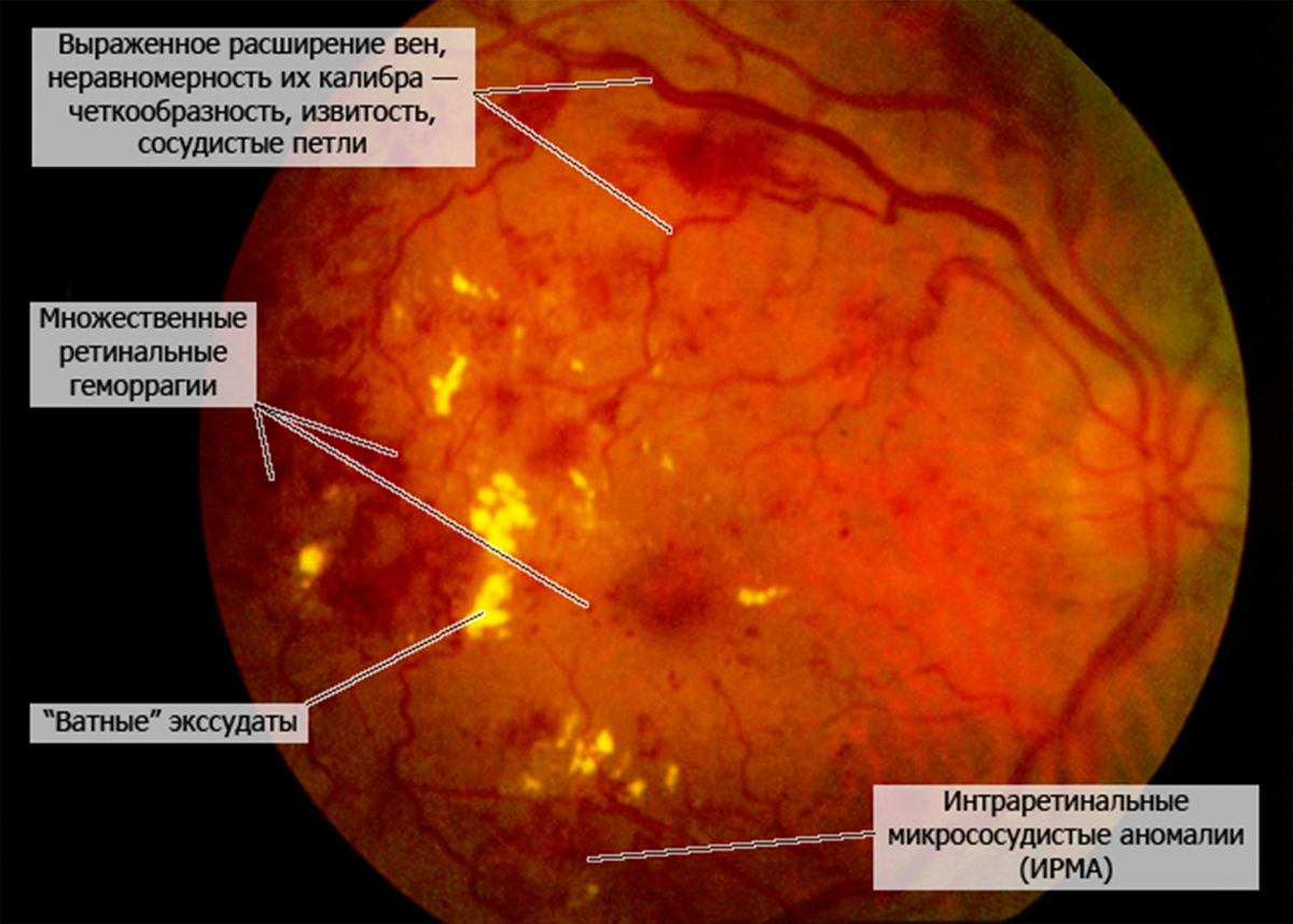 Изменения глазного дна при препролиферативной ДР