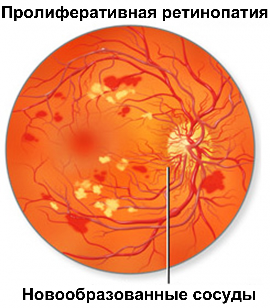 Изменения глазного дна при ПДР