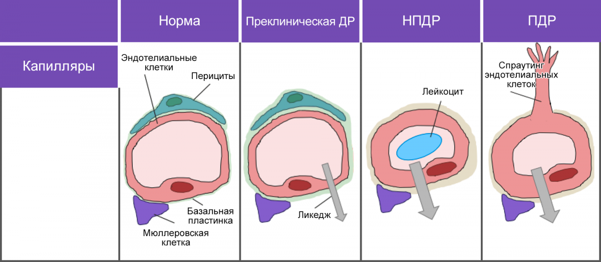 Рисунок 3. Морфологические изменения в зависимости от стадии ДР Морфологические изменения в зависимости от стадии ДР