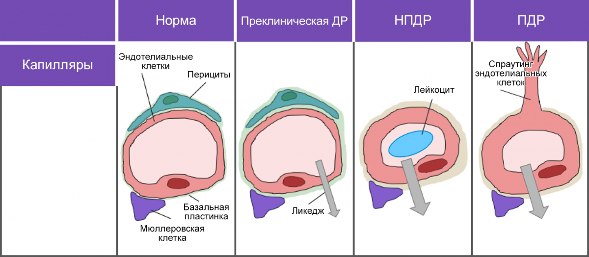 Морфологические изменения в зависимости от стадии ДР