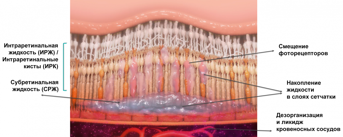 Виды жидкости в сетчатке