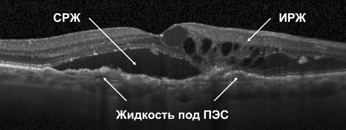 Пациент с активной нВМД