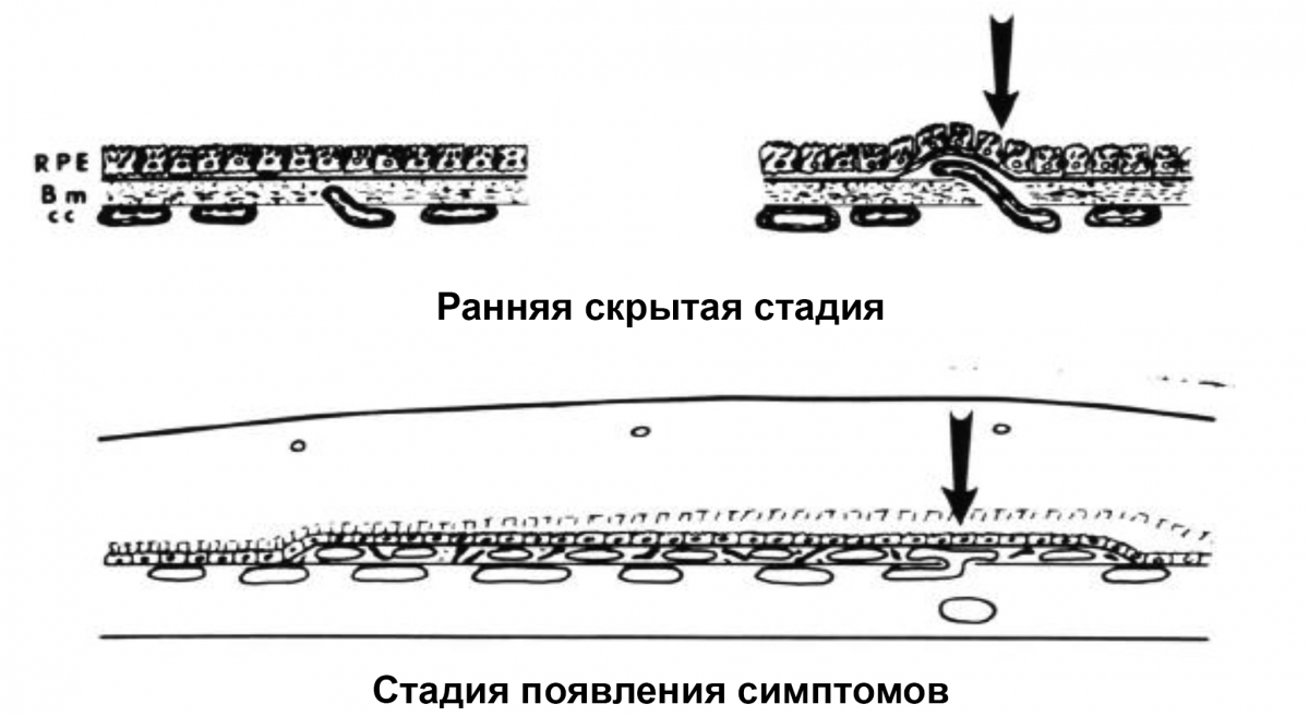 Рисунок 1. ХНВ 1 типа ХНВ 1 типа