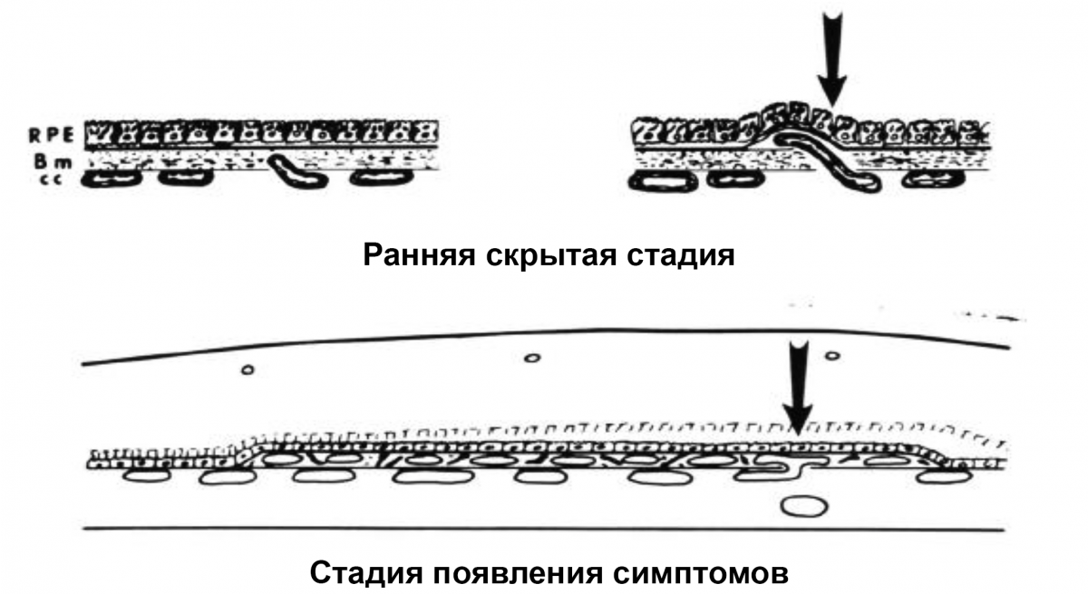 ХНВ 1 типа