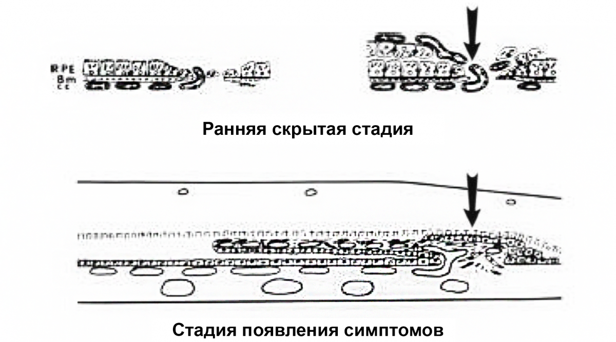 Рисунок 2. ХНВ 2 типа ХНВ 2 типа