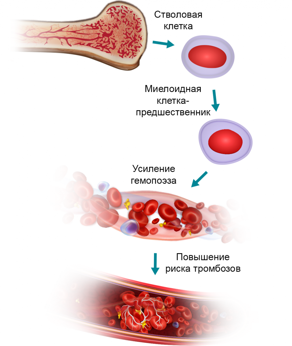 Механизмы развития тромботических осложнений