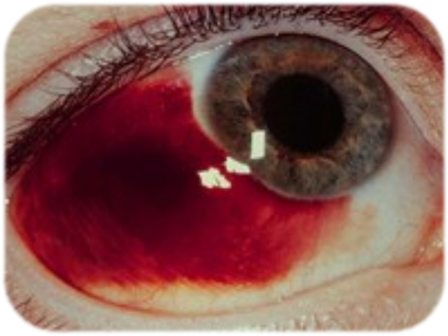 Проявление ИТП кровоточивость белок глаза