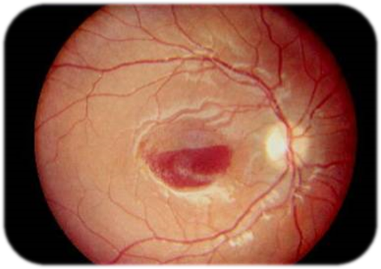 Проявление ИТП кровоточивость сетчатка глаза