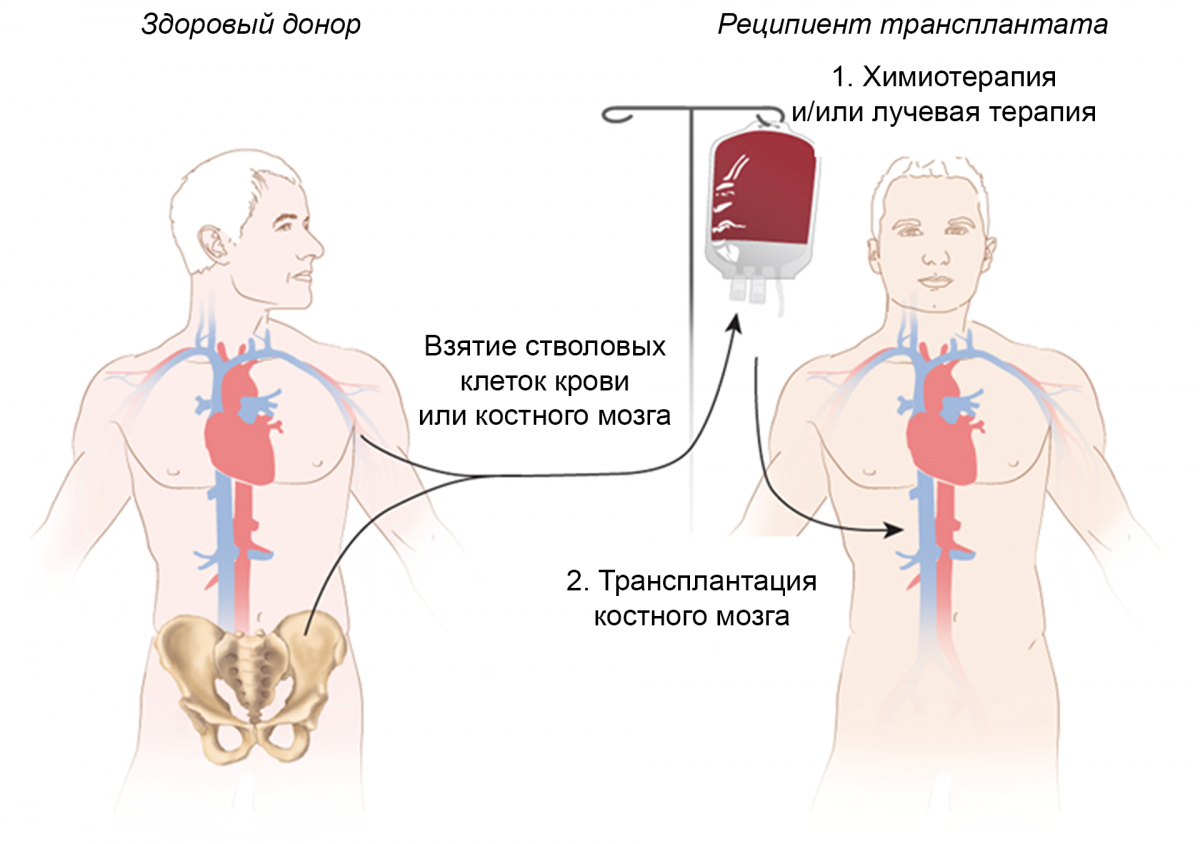 Аллогенная/сингенная трансплантация гемопоэтических стволовых клеток