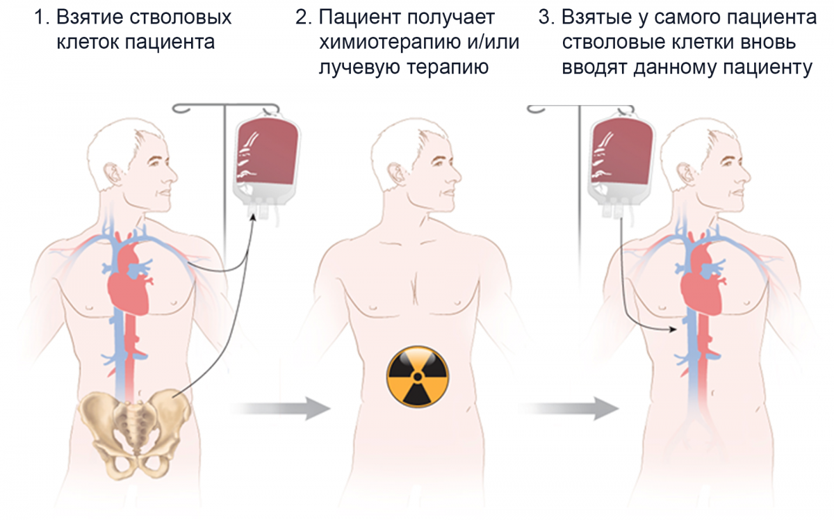 Аутологичная трансплантация гемопоэтических стволовых клеток