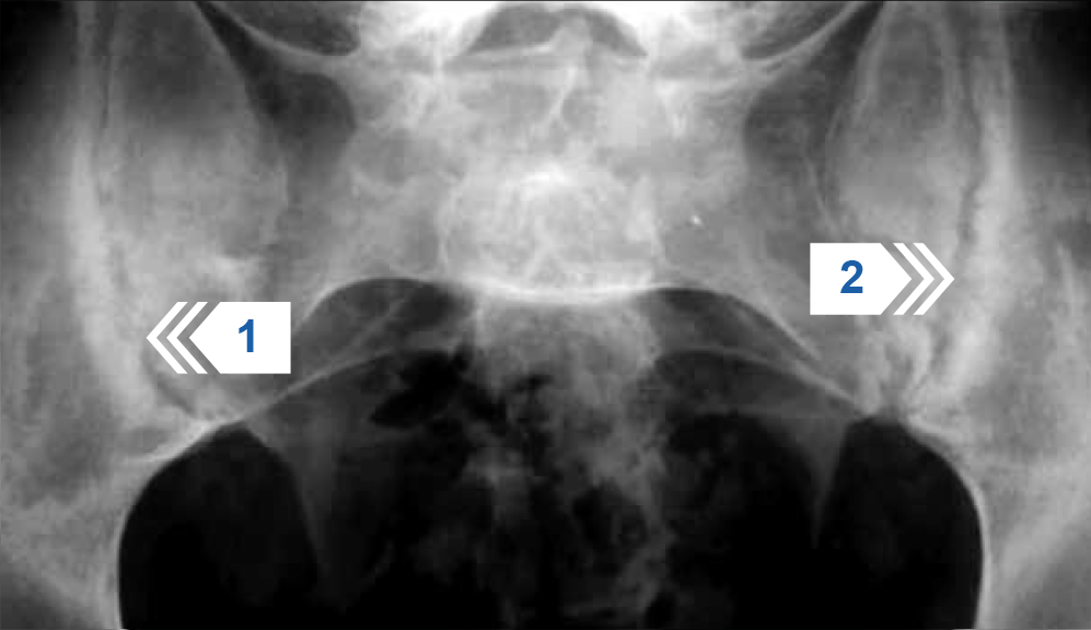 Рентгенография крестцово-подвздошных суставов в прямой проекции