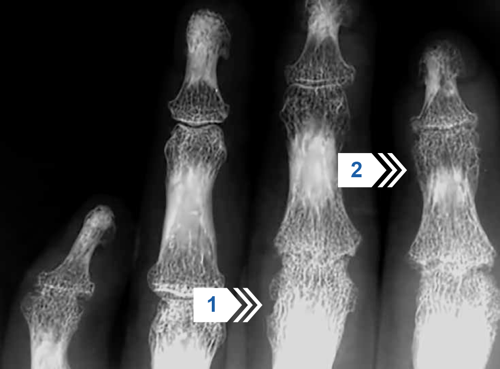 Прицельная рентгенография межфаланговых суставов кисти
