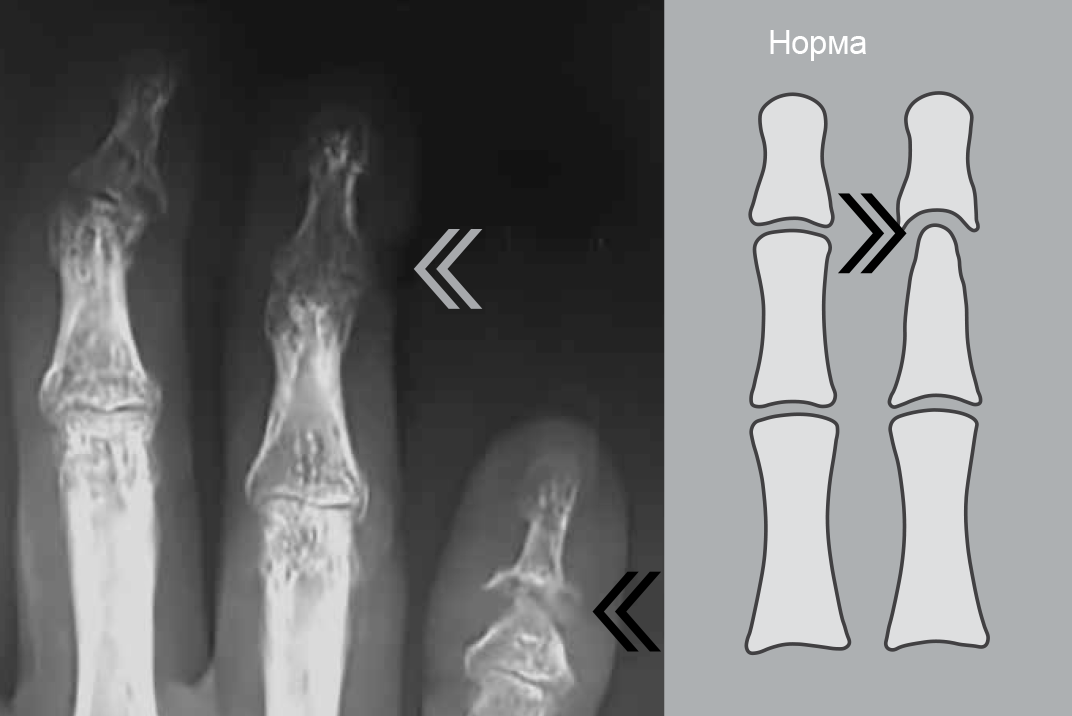 Рисунок 12 — «Карандаш в колпачке» , анкилоз дистального межфалангового сустава «Карандаш в колпачке» , анкилоз дистального межфалангового сустава