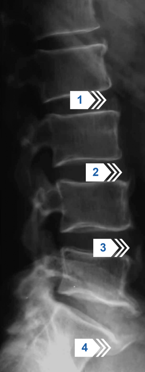 Рентгенография поясничного отдела позвоночника в боковой проекции
