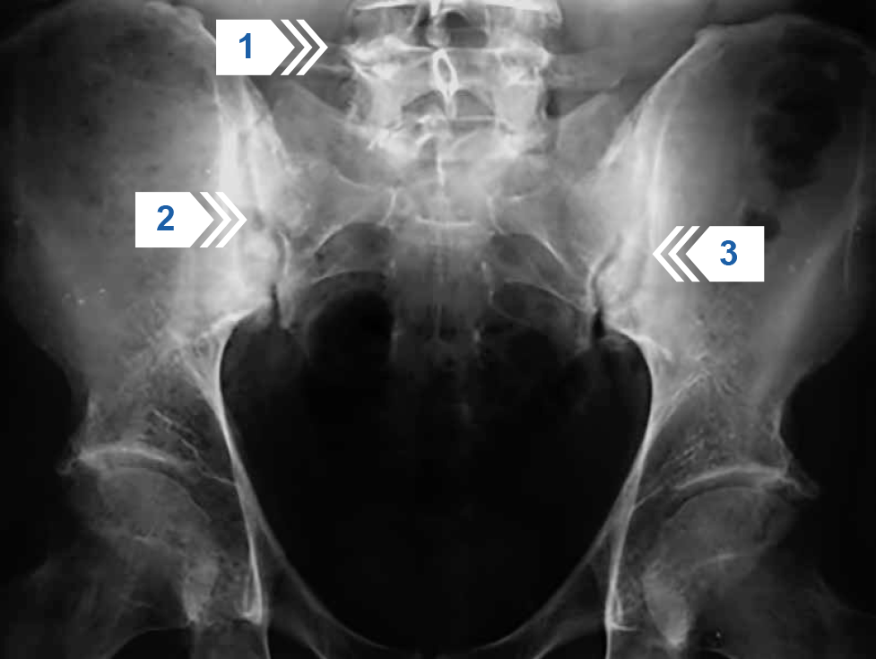 Обзорная рентгенография таза. Двухсторонний сакроилиит 3 стадии