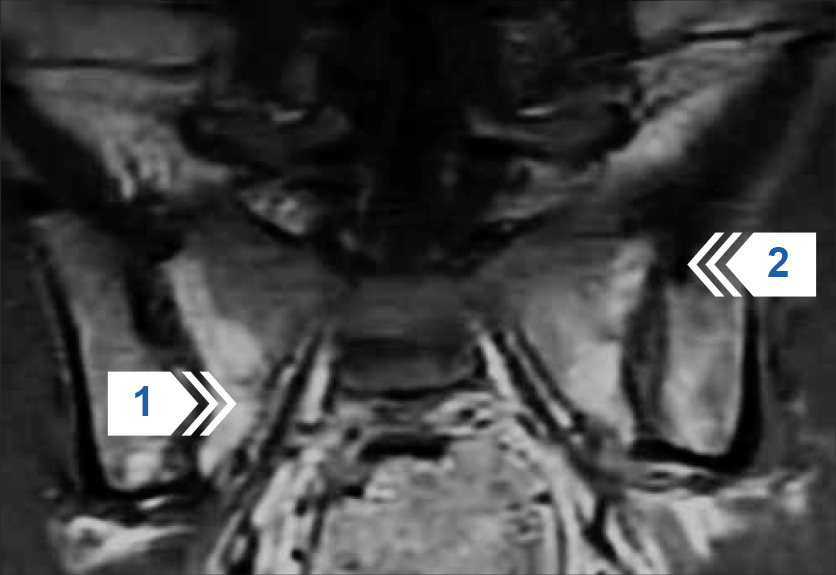 МРТ крестцово-подвздошных суставов в полу-корональной проекции (режим Т1)