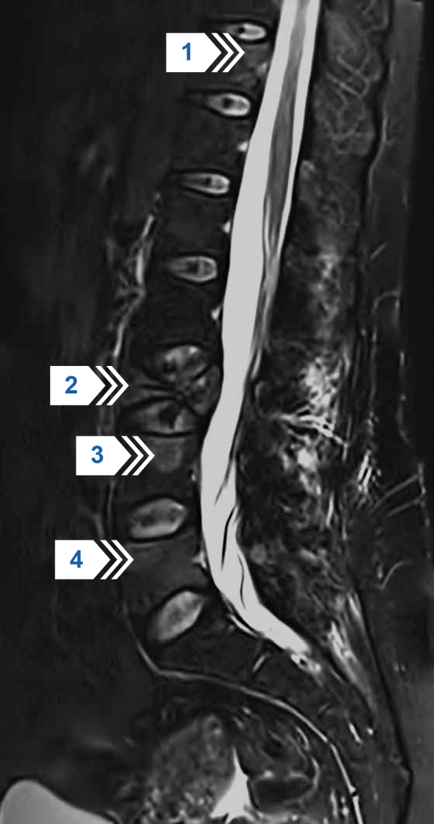 МРТ поясничного отдела позвоночника в боковой проекции в режиме STIR T2