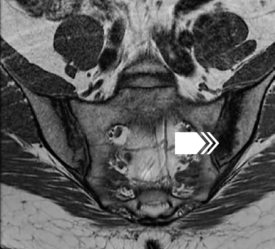 МРТ крестцово-подвздошных суставов в корональной проекции в режиме Т1