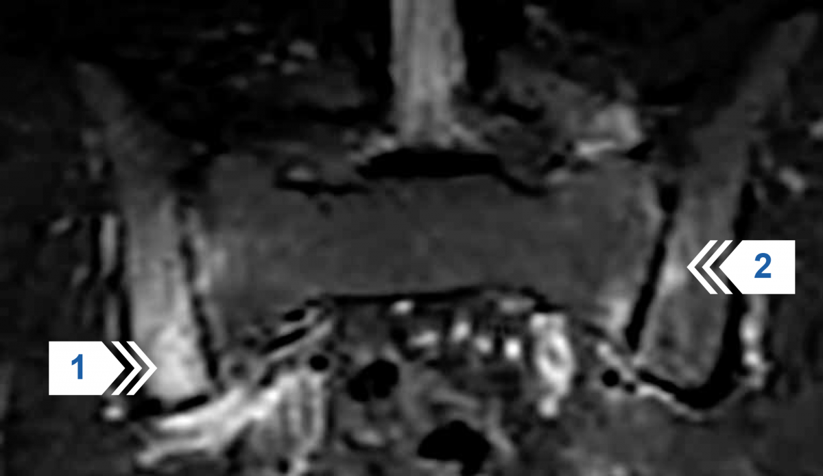 МРТ крестцово-подвздошных суставов в режиме STIR T2