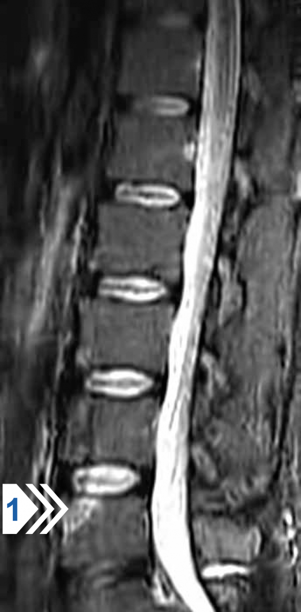МРТ поясничного отдела позвоночника в боковой проекции