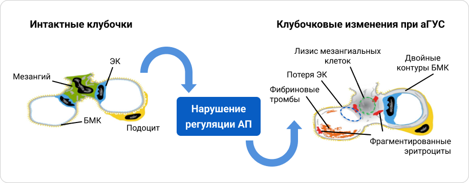 Роль системы комплемента в патогенезе аГУС