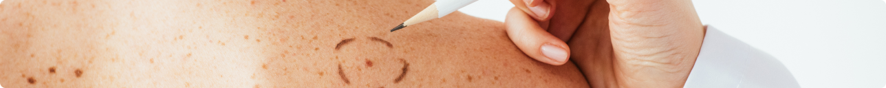 Тройная комбинация – оправдала ли ожидания новая схема лечения метастатической меланомы кожи?