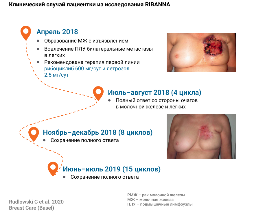 Клинический случай пациентки из исследования RIBANNA