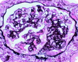 Сегментарный гломерулосклероз (более четырех мезангиальных клеток)