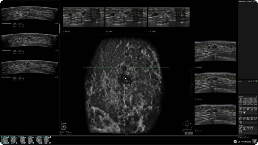 Breast ultrasound techniques