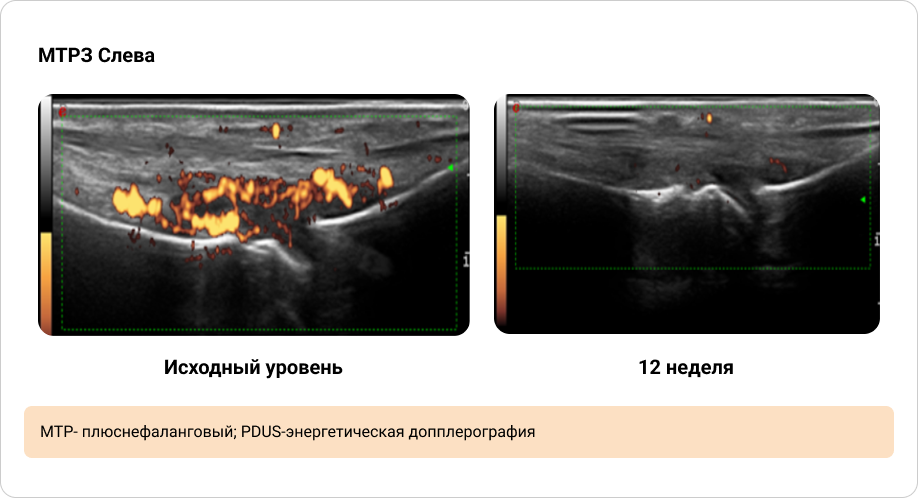 Приложение 4. Иллюстрация динамики синовита, выявленного при PDUS исходно и через 12 недель терапии (1/2)