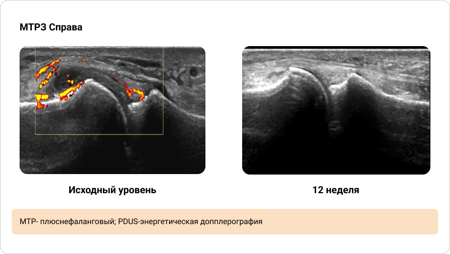 Приложение 5. Иллюстрация динамики синовита, выявленного при PDUS исходно и через 12 недель терапии (2/2)