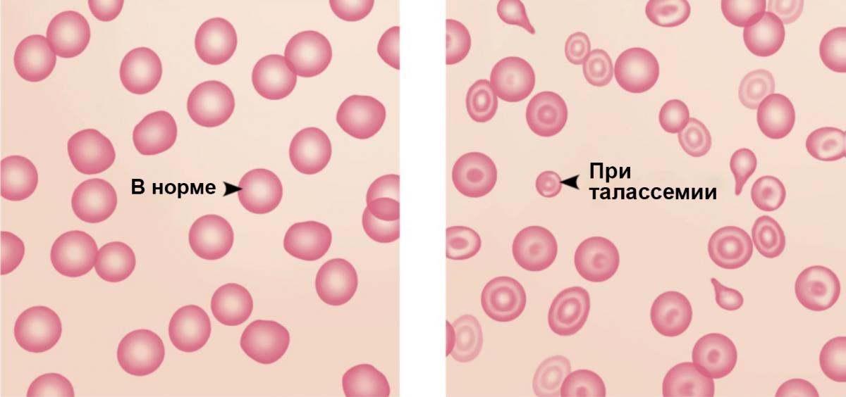 Эритроциты в норме и при талассемии